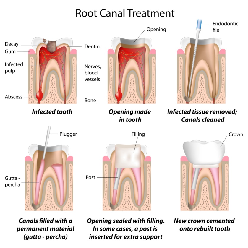 rootcanal1