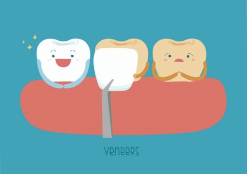 veneers1 veneers1