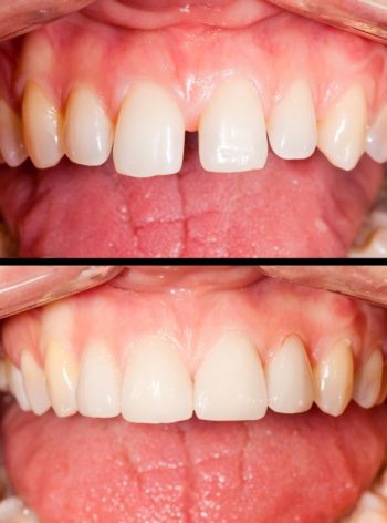veneers2 veneers2
