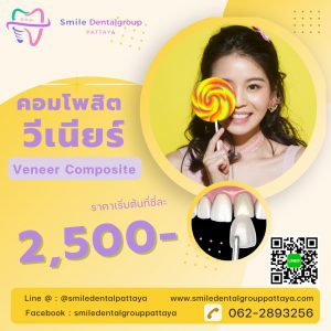 คอมโพสิต วีเนียร์ ราคา