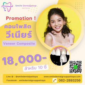 veneer composite 18000