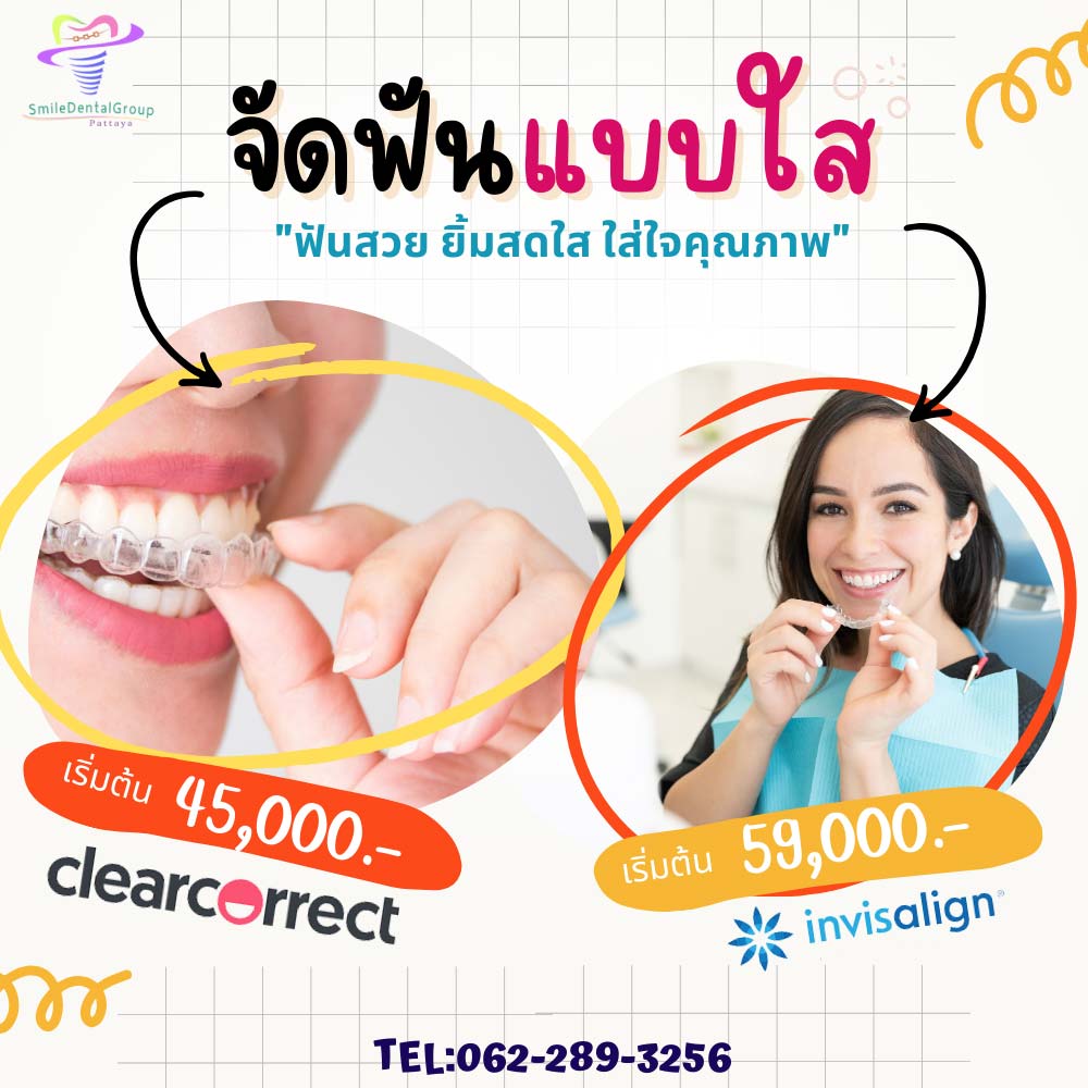 จัดฟันใส-pty